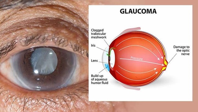 Tăng nhãn áp là chứng bệnh diễn ra bên võng mạc khi thủy dịch tăng nhưng ống thoát bị tắc nghẽn gây áp lực trực tiếp lên mắt của bệnh nhân