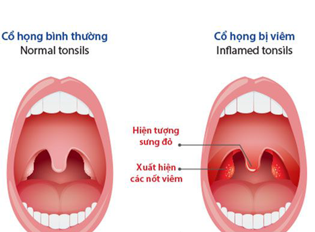Ho viêm họng kéo dài thường xảy ra do vi khuẩn, virus tấn công gây viêm niêm mạc họng